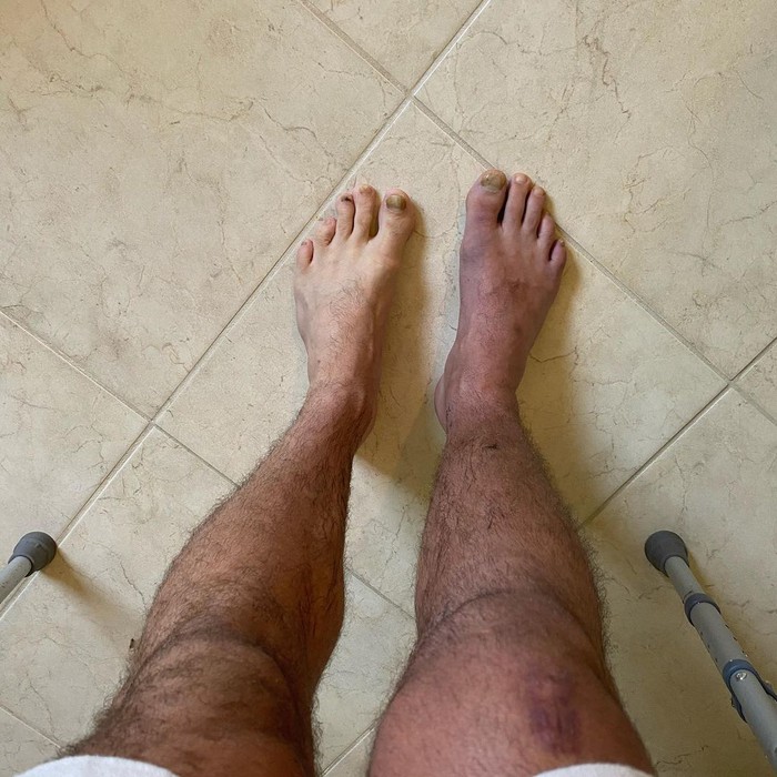 Cựu vương Chris Weidman cập nhật tình hình sau 3 tuần bị gãy chân: Nó đang có màu khác so với bên còn lại - Ảnh 1.
